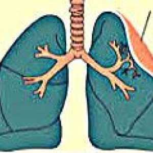 Plućni atelektaza