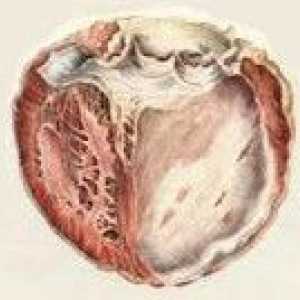 Aterosklerotskih kardio