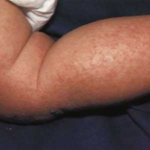 Atopijski dermatitis kod djece i odraslih