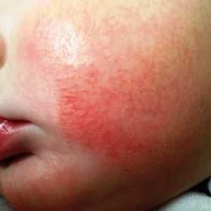 Atopijski dermatitis u djece