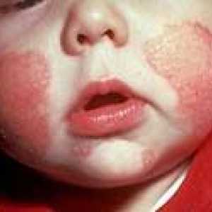 Atopijskog dermatitisa