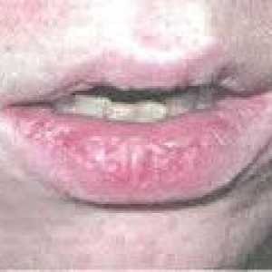 Atopijski inflamacija usana