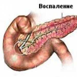Bilijarna pankreatitis