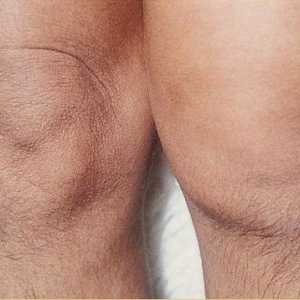 Bol u koljenu (zglob koljena)