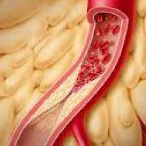 Crijevnih angina