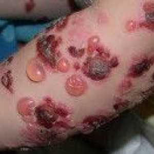 Bulozna dermatitis