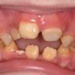 Dental nedostataka