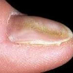 Deformacije noktiju