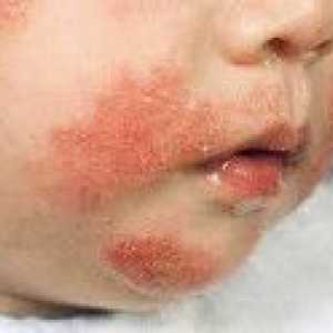 Dermatitis kod djece