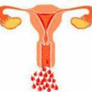 Disfunkcionalno krvarenje iz uterusa