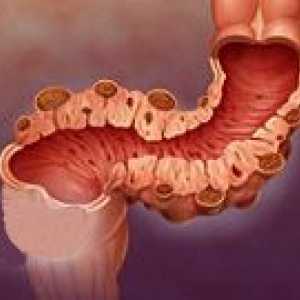 Divertikuli sigmoidnog debelog crijeva