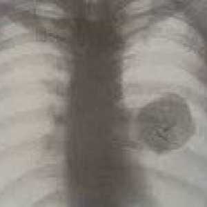 Benigni raka pluća