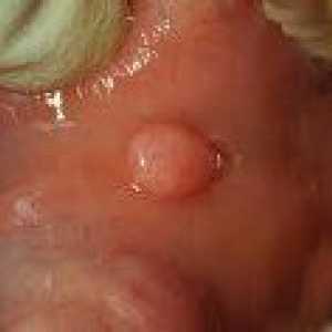 Benigni tumori usne šupljine