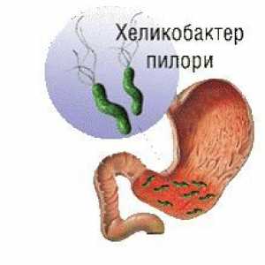 Gastritis: uzroci, simptomi, liječenje, dijeta