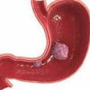 Gastrointestinalni stromalni tumori