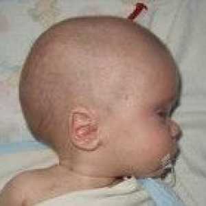 Hidrocefalusa u djece