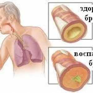 Hronični bronhitis