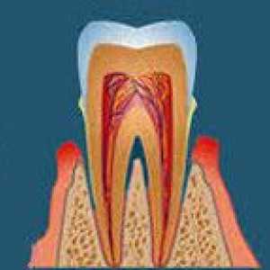 Hronični parodontitis