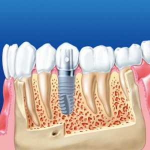 Dentalnih implantata