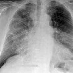 Intersticijske pneumonije