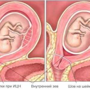 Cervikalni nesposobnost (CIN) u trudnoći