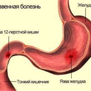 Ulkusi (peptički ulkus bolest), želuca i duodenuma