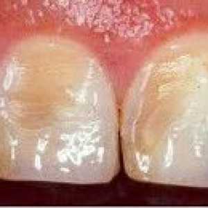 Dentalne erozije