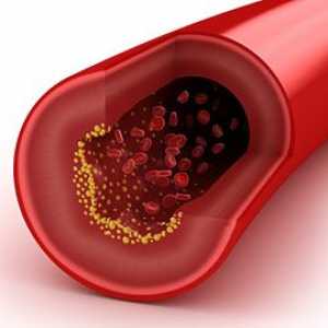 Kako smanjiti holesterol u krvi?
