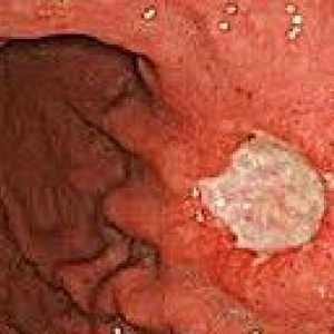 Karcinoidnih tumora gastrointestinalnog trakta