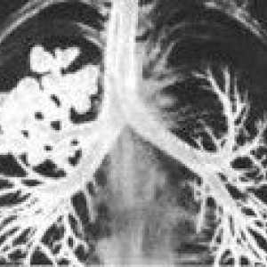 Cistična pluća hipoplazija