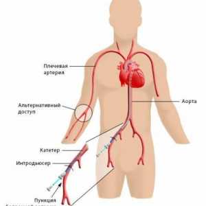 Koronarna angiografija (koronarne)