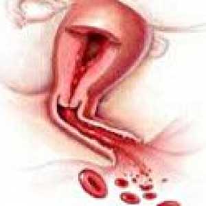 Maternice krvarenje