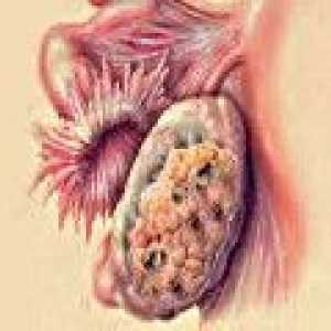 Jajnika metastatskog karcinoma