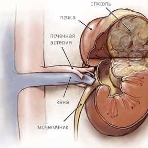Bubrega nefroblastom (Wilms 'tumora) u djece
