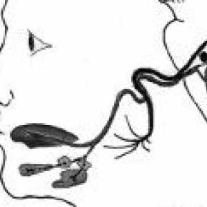 Neuralgija submandibularnoj i sublingvalne čvorova