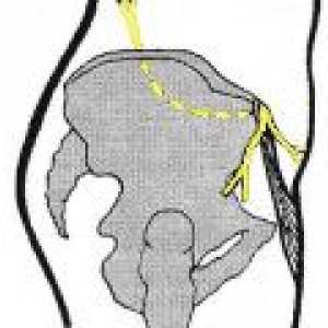 Neuropatija vanjski femoralne kožnog živca