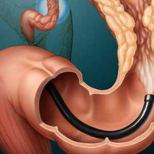 Tumor debelog crijeva: Simptomi