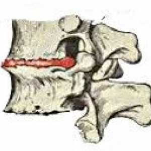 Osteohondroze