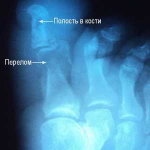 Osteomijelitis
