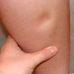 Oticanje nogu tokom trudnoće