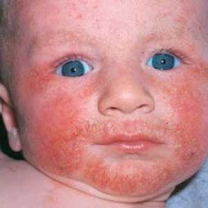 Alergije na hranu kod djece