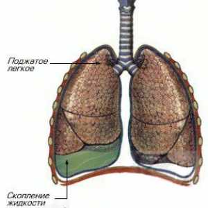 Zapaljenje plućne maramice