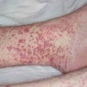 Polimorfna kožni vaskulitis