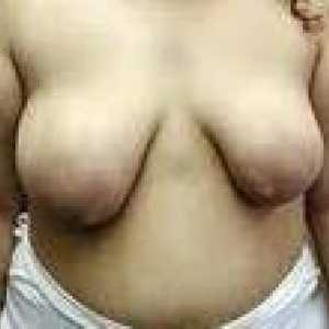 Malformacije dojke