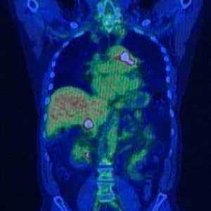 Pozitronske emisijske tomografije (PET)