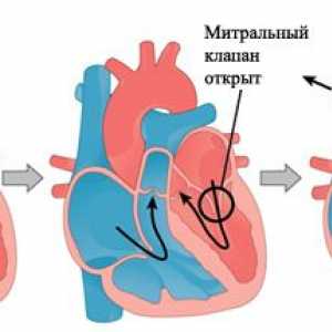 Prolaps mitralne srčanih zalistaka