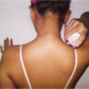 Akne na leđima i ramenima