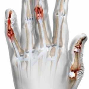 Psorijatični artritis: Simptomi i tretman