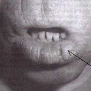 Rak usne, usne šupljine i ždrijela (grla)