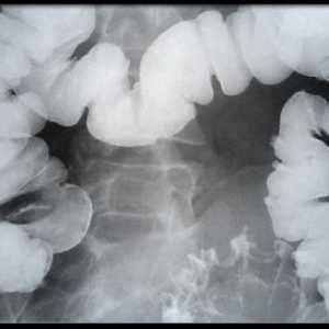Crijeva x-ray barijevog: Posebni postupak
